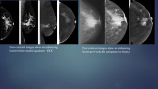 Post-contrast images show an enhancing
lesion infero-medial quadrant - DCC
Post contrast images show an enhancing
lesion proved to be malignant on biopsy
 