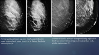 Normal glandular tissues are more clearly depicted on the
breast tomosynthesis image (arrows in a) than on the digital
mammogram (b).
Normal lactiferous ducts are more prominently depicted on
the breast tomosynthesis image (arrows in a) than on the
digital mammogram (b).
 
