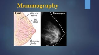 Mammography
 