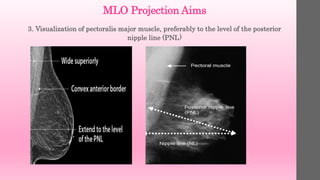 MLO Projection Aims
3. Visualization of pectoralis major muscle, preferably to the level of the posterior
nipple line (PNL)
 