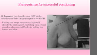 Prerequisites for successful positioning
2d. Incorrect: the shoulders are NOT at the
same level and the image receptor is too HIGH
• Raising the image receptor too high will
elevate the arm higher, stretching the pectoral
muscle and causing difficulty in pulling the
breast into view
 