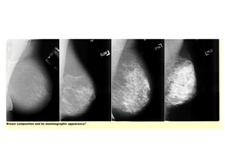 Mammogram Slides Mammography presentation | PPT