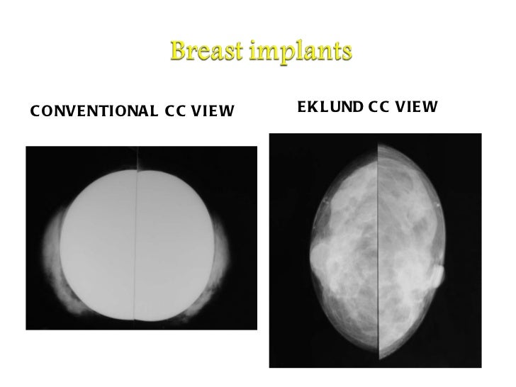 Mammography presentation