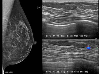 Case 11 Keys
Subcentimeter mass in the superior left breast requires
additional evaluation.
     If no sonographic correla...