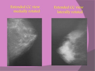 Mammogram Slides Mammography | PPTX