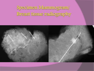 Mammography | PPTX