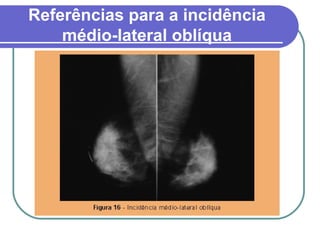 Referências para a incidência
    médio-lateral oblíqua
 
