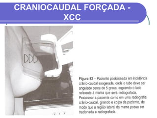 CRANIOCAUDAL FORÇADA -
         XCC
 