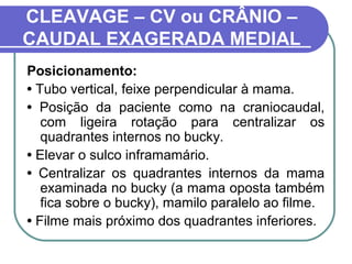 CLEAVAGE – CV ou CRÂNIO –
CAUDAL EXAGERADA MEDIAL
Posicionamento:
• Tubo vertical, feixe perpendicular à mama.
• Posição da paciente como na craniocaudal,
   com ligeira rotação para centralizar os
   quadrantes internos no bucky.
• Elevar o sulco inframamário.
• Centralizar os quadrantes internos da mama
   examinada no bucky (a mama oposta também
   fica sobre o bucky), mamilo paralelo ao filme.
• Filme mais próximo dos quadrantes inferiores.
 