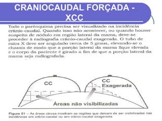 CRANIOCAUDAL FORÇADA -
         XCC
 