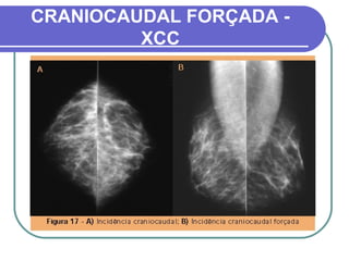 CRANIOCAUDAL FORÇADA -
         XCC
 
