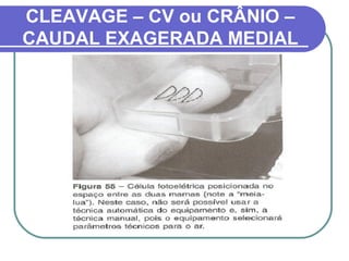 CLEAVAGE – CV ou CRÂNIO –
CAUDAL EXAGERADA MEDIAL
 