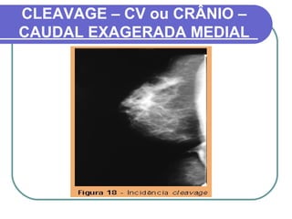 CLEAVAGE – CV ou CRÂNIO –
CAUDAL EXAGERADA MEDIAL
 