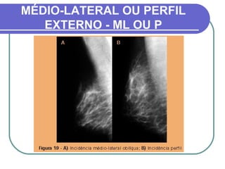 MÉDIO-LATERAL OU PERFIL
   EXTERNO - ML OU P
 