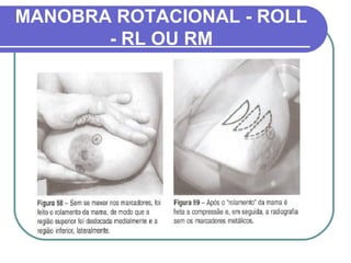 MANOBRA ROTACIONAL - ROLL
       - RL OU RM
 