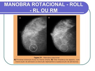 MANOBRA ROTACIONAL - ROLL
       - RL OU RM
 