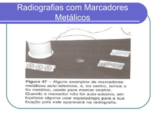 Radiografias com Marcadores
          Metálicos
 