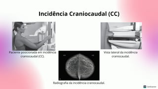 Incidência Craniocaudal (CC)
Vista lateral da incidência
craniocaudal.
Paciente posicionada em incidência
craniocaudal (CC).
Radiografia da incidência craniocaudal.
 