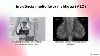 Incidência médio-lateral oblíqua (MLO)
Paciente posicionada em incidência
médio-lateral oblíqua (MLO).
Radiografia na incidência mediolateral
oblíqua.
 