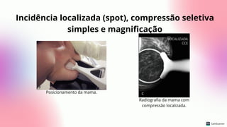 Incidência localizada (spot), compressão seletiva
simples e magnificação
Posicionamento da mama.
Radiografia da mama com
compressão localizada.
 