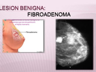 LESION BENIGNA:
FIBROADENOMA
Un fibroadenoma es un tumor benigno no
canceroso que se encuentra en
el tejido mamario.
 
