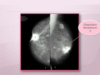 Diagnóstico
fibroadenom
a
 