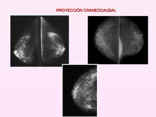 PROYECCIÓN CRANEOCAUDAL 