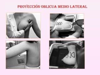 PROYECCIÓN OBLICUA MEDIO LATERAL 