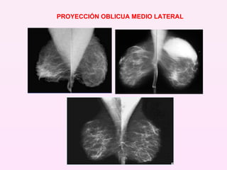 PROYECCIÓN OBLICUA MEDIO LATERAL 