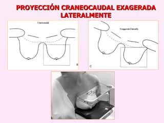 PROYECCIÓN CRANEOCAUDAL EXAGERADA LATERALMENTE 