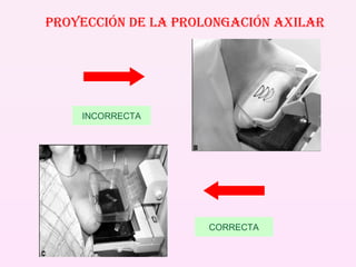 PROYECCIÓN DE LA PROLONGACIÓN AXILAR INCORRECTA CORRECTA 