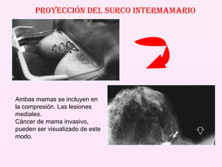 PROYECCIÓN DEL SURCO INTERMAMARIO Ambas mamas se incluyen en la compresión. Las lesiones mediales. Cáncer de mama invasivo, pueden ser visualizado de este modo. 