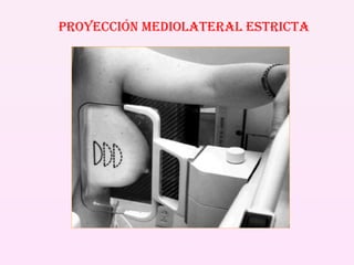 PROYECCIÓN MEDIOLATERAL ESTRICTA 