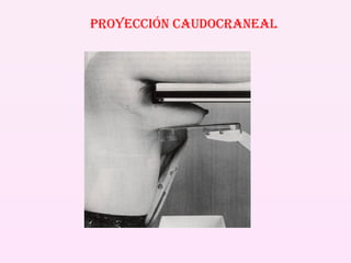 PROYECCIÓN CAUDOCRANEAL 