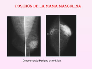 Posición de la mama masculina Ginecomastia benigna asimétrica 