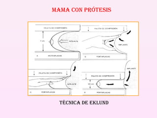 Mama con PRÓTESIS Técnica de EKLUND 