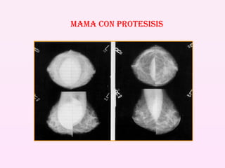 MAMA CON PROTESISIS 