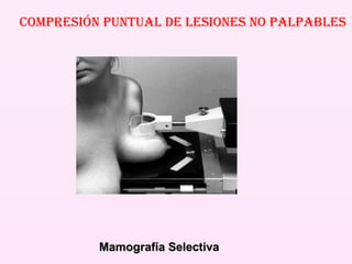 COMPRESIÓN PUNTUAL DE LESIONES NO PALPABLES Mamografía Selectiva 