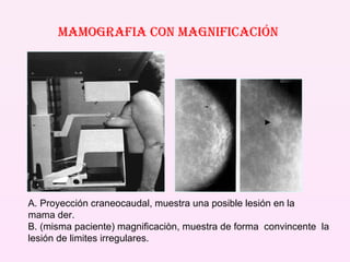 MAMOGRAFIA CON MAGNIFICACIÓN A. Proyección craneocaudal, muestra una posible lesión en la  mama der. B. (misma paciente) magnificaciòn, muestra de forma  convincente  la lesión de limites irregulares. 