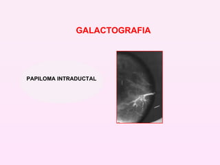 PAPILOMA INTRADUCTAL GALACTOGRAFIA   