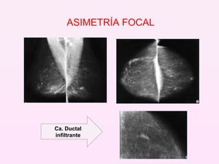 Ca. Ductal infiltrante ASIMETRÍA FOCAL 