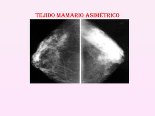 TEJIDO MAMARIO ASIMÉTRICO 