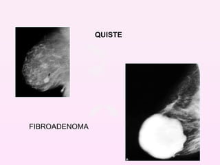 QUISTE FIBROADENOMA 