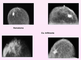 Hematoma Ca. Infiltrante 