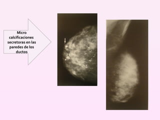 Micro calcificaciones  secretoras en las paredes de los ductos 