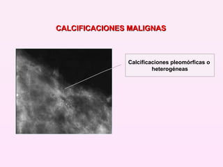Calcificaciones pleomórficas o  heterogéneas CALCIFICACIONES MALIGNAS 