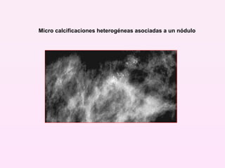 Micro calcificaciones heterogéneas asociadas a un nódulo   