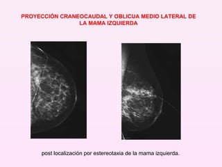 PROYECCIÓN CRANEOCAUDAL Y OBLICUA MEDIO LATERAL DE LA MAMA IZQUIERDA post localización por estereotaxia de la mama izquierda. 