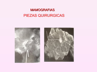 PIEZAS QUIRURGICAS  MAMOGRAFIAS 