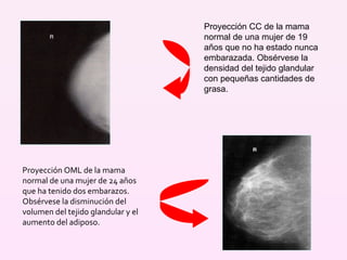 Proyección CC de la mama normal de una mujer de 19 años que no ha estado nunca embarazada. Obsérvese la densidad del tejido glandular con pequeñas cantidades de grasa. Proyección OML de la mama normal de una mujer de 24 años que ha tenido dos embarazos. Obsérvese la disminución del volumen del tejido glandular y el aumento del adiposo. 